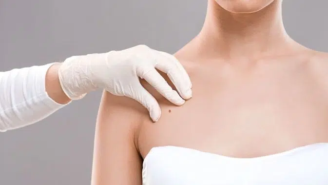 Yuk Kenali, Gejala Kanker Payudara Pada Wanita Remaja