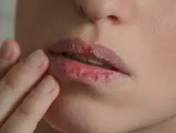 4 Cara Sederhana yang Bisa Atasi Bibir Kering dan Pecah-pecah