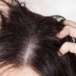 5 Hal yang Terjadi pada Tubuh Ketika Rambut Ketombean