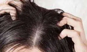5 Hal yang Terjadi pada Tubuh Ketika Rambut Ketombean