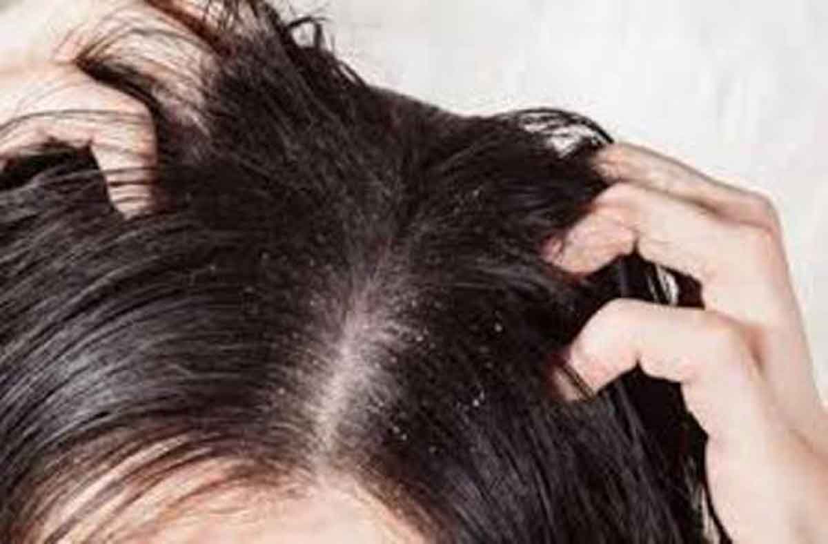 5 Hal yang Terjadi pada Tubuh Ketika Rambut Ketombean
