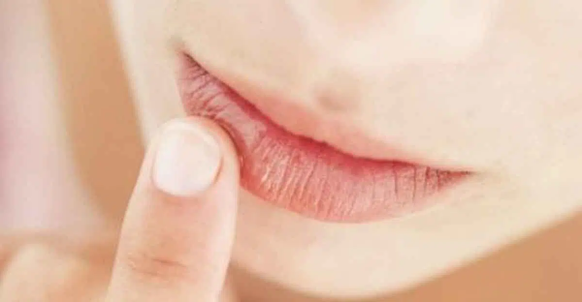 4 Cara Gunakan Minyak Kelapa untuk Bibir Kering dan Pecah-pecah