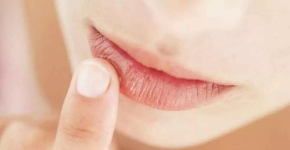 4 Cara Gunakan Minyak Kelapa untuk Bibir Kering dan Pecah-pecah