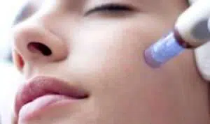 Kenali 4 Manfaat Perawatan Wajah Microneedling Bagi Kecantikan Kulit