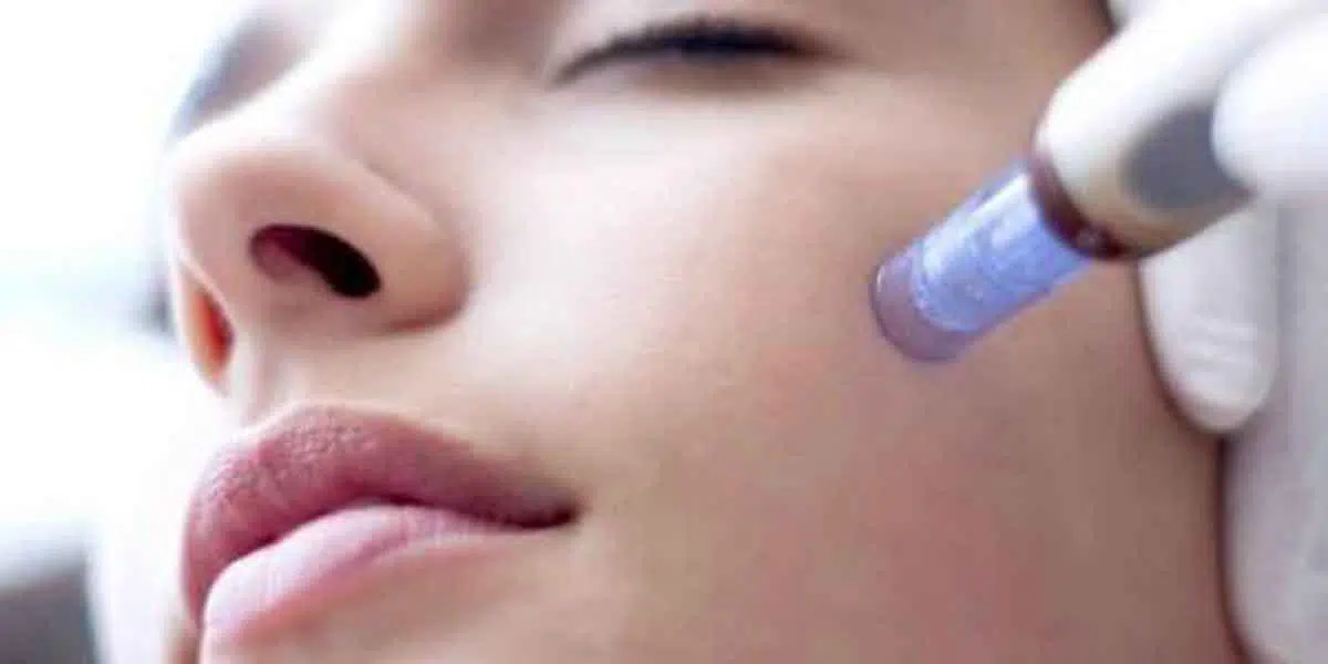 Kenali 4 Manfaat Perawatan Wajah Microneedling Bagi Kecantikan Kulit