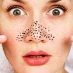 5 Cara Mudah Hilangkan Blackheads di Wajah Anda