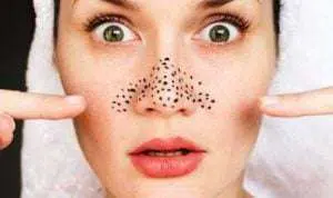 5 Cara Mudah Hilangkan Blackheads di Wajah Anda