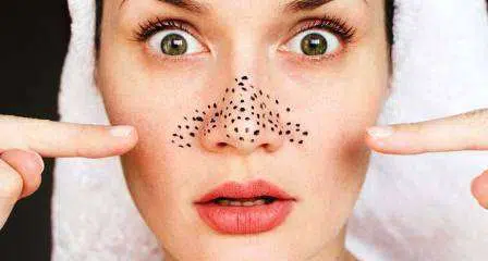 5 Cara Mudah Hilangkan Blackheads di Wajah Anda