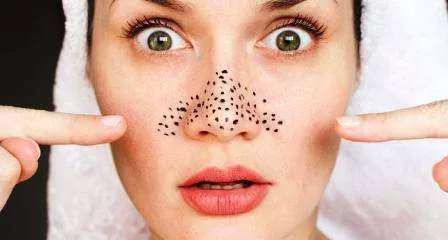 5 Cara Mudah Hilangkan Blackheads di Wajah Anda
