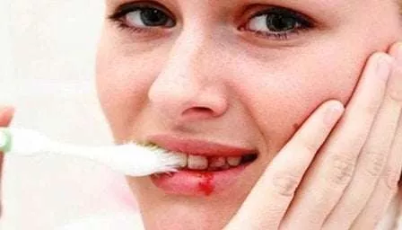 5 Penyebab Gusi Berdarah Yang Patut Diwaspadai - Portalmadura.com 5 Penyebab Gusi Berdarah yang Patut Diwaspadai