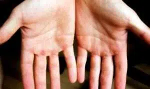 Hilangkan Kapalan di Tangan Anda dengan 4 Tips Ampuh Ini!