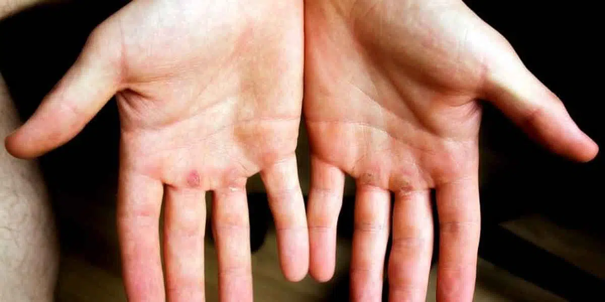 Hilangkan Kapalan di Tangan Anda dengan 4 Tips Ampuh Ini!