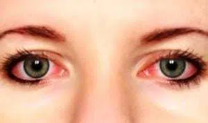 6 Penyebab Mata Merah Ketika Gunakan Softlens