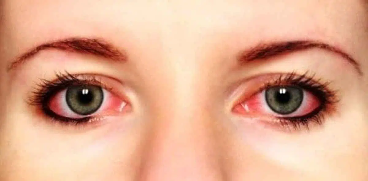 6 Penyebab Mata Merah Ketika Gunakan Softlens