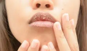 3 Cara Mengatasi Bibir Kering Selama Ramadan