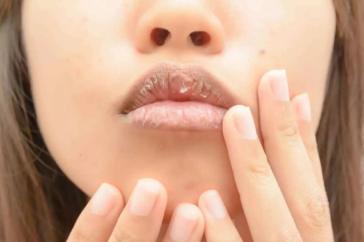 3 Cara Mengatasi Bibir Kering Selama Ramadan