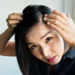 Begini 5 Tips Menghilangkan Jerawat di Sekitar Kulit Rambut