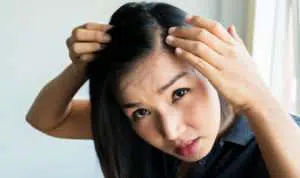 Begini 5 Tips Menghilangkan Jerawat di Sekitar Kulit Rambut