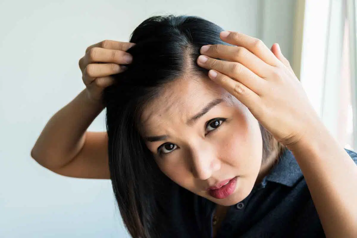 Begini 5 Tips Menghilangkan Jerawat di Sekitar Kulit Rambut