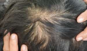 Rambut Tipis? Begini 5 Tips yang Tepat saat Mencucinya