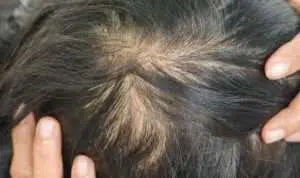 Rambut Tipis? Begini 5 Tips yang Tepat saat Mencucinya