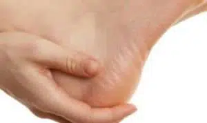 Kapalan di Telapak Kaki Ternyata Memiliki Manfaat Lho?