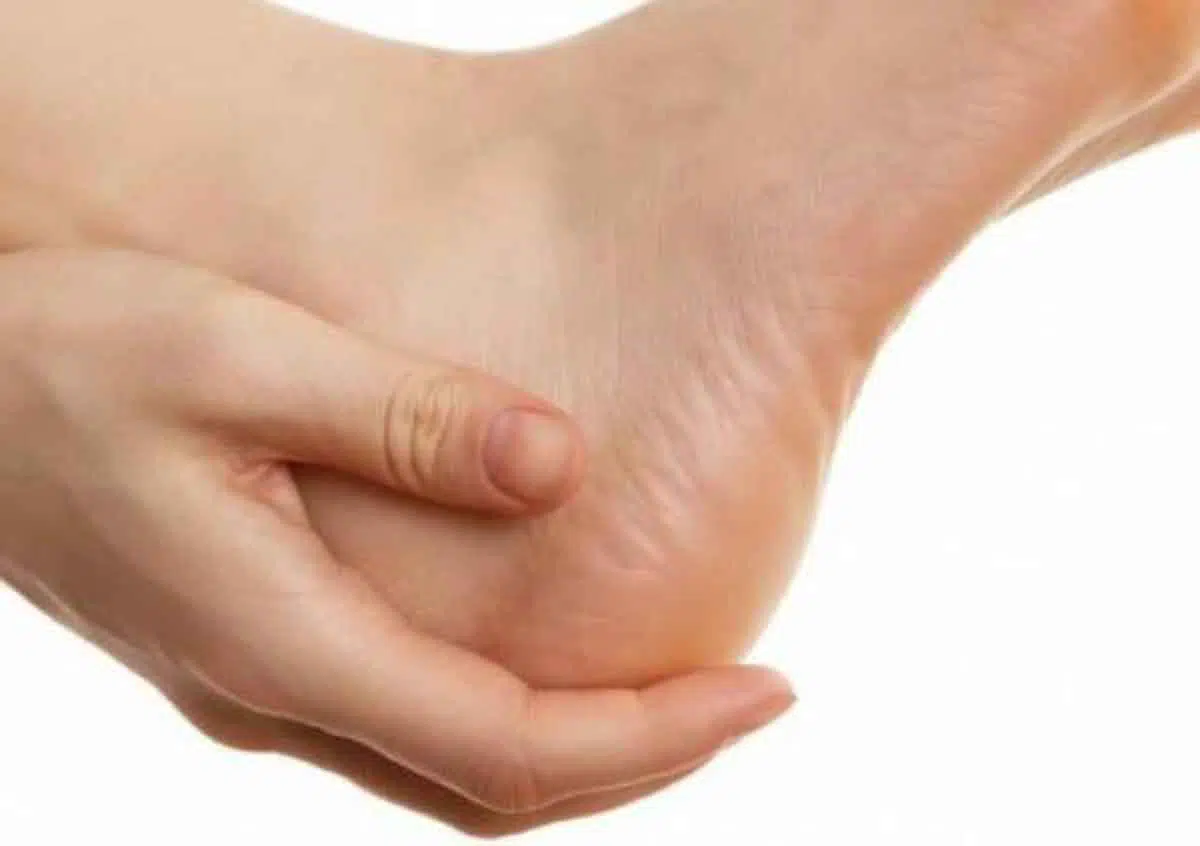 Kapalan di Telapak Kaki Ternyata Memiliki Manfaat Lho?