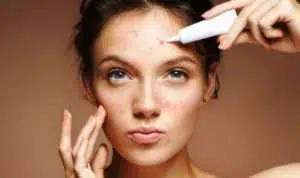 Perbedaan Jerawat Batu dan Rosacea yang Harus Anda Ketahui
