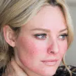 Penderita Rosacea, 5 Kandungan Skincare Ini Perlu Anda Hindari