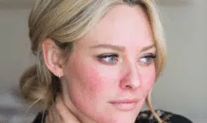Penderita Rosacea, 5 Kandungan Skincare Ini Perlu Anda Hindari