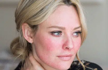 Penderita Rosacea, 5 Kandungan Skincare Ini Perlu Anda Hindari