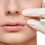 Dampak Negatif Sering Suntik Jerawat, Hati-hati!