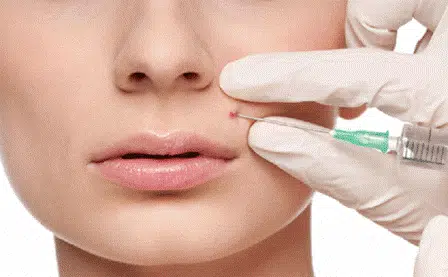 Dampak Negatif Sering Suntik Jerawat