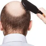 Meski Bisa Atasi Kebotakan, Ini 4 Efek Samping Transplantasi Rambut