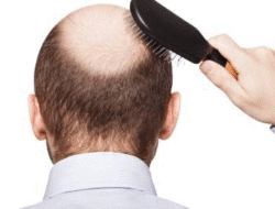 Meski Bisa Atasi Kebotakan, Ini 4 Efek Samping Transplantasi Rambut