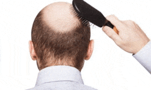 Meski Bisa Atasi Kebotakan, Ini 4 Efek Samping Transplantasi Rambut