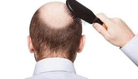 Meski Bisa Atasi Kebotakan, Ini 4 Efek Samping Transplantasi Rambut