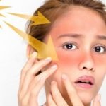 Atasi Kulit Sunburn dengan 3 Cara Ini
