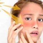 Atasi Kulit Sunburn dengan 3 Cara Ini