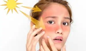 Atasi Kulit Sunburn dengan 3 Cara Ini