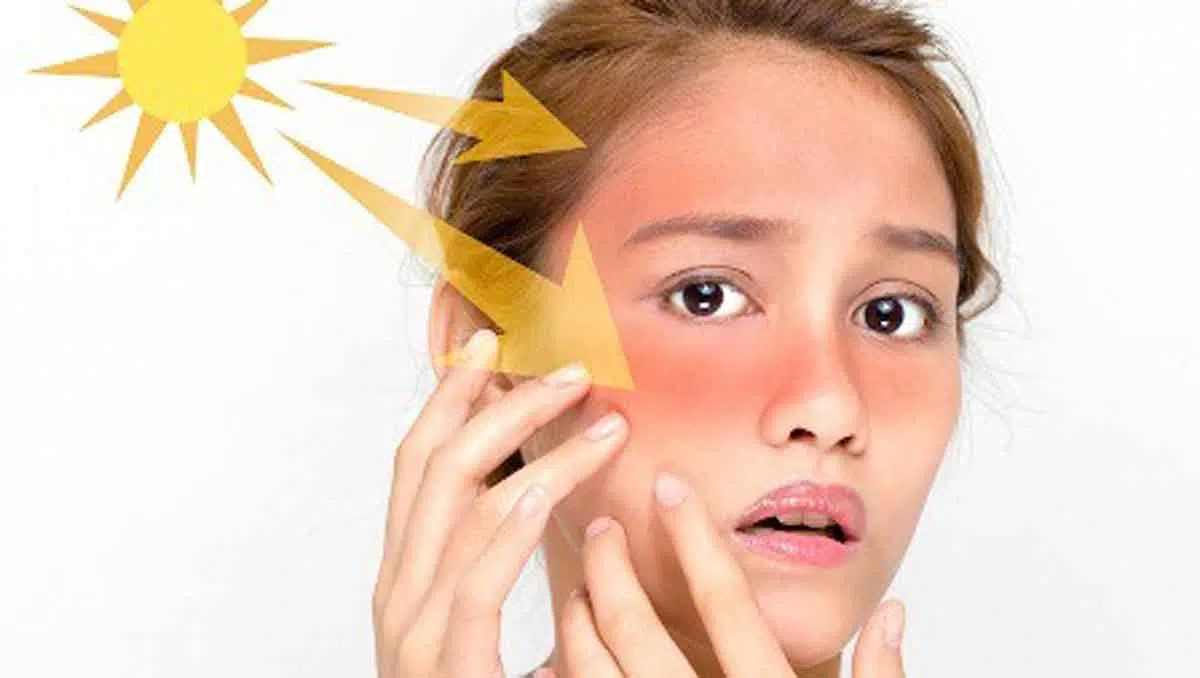 Atasi Kulit Sunburn dengan 3 Cara Ini