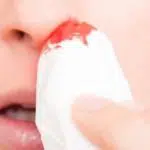 Mimisan Bisa Jadi Tanda 5 Penyakit Ini