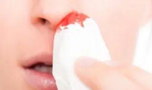 Mimisan Bisa Jadi Tanda 5 Penyakit Ini
