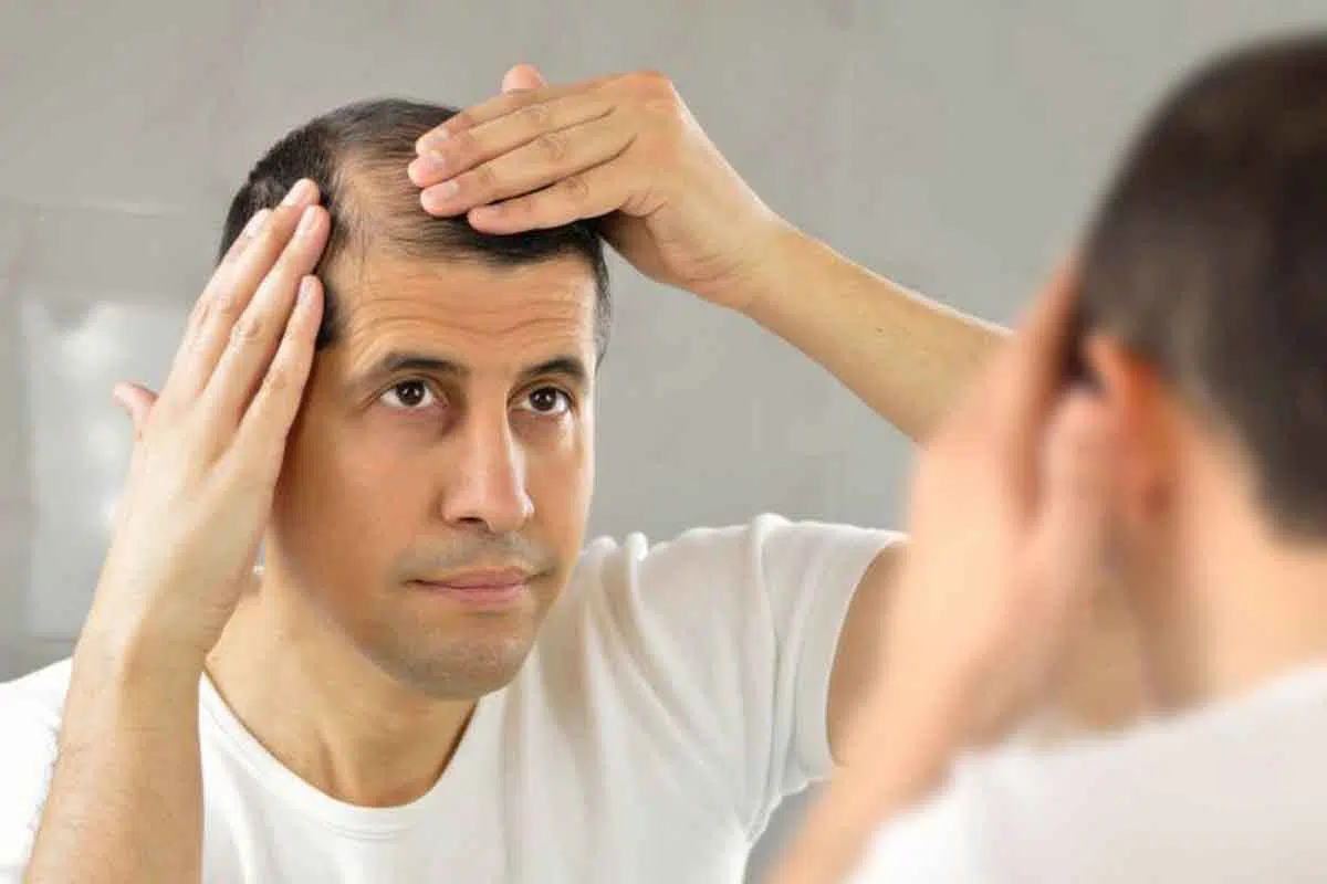 5 Makanan Ini bisa Mencegah Kebotakan pada Rambut Anda