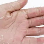 5 Penyakit Kulit yang Akan Muncul di Musim Hujan