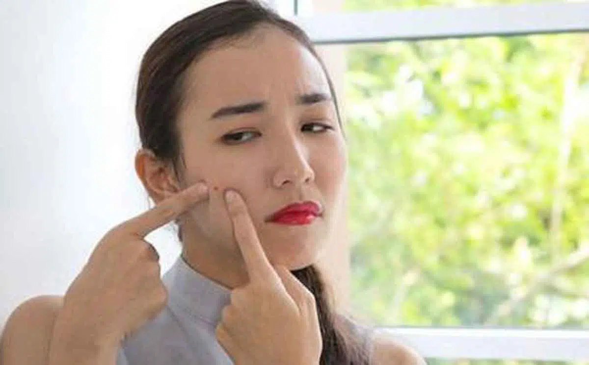 5 Jenis Jerawat Ini Bisa Disamarkan dengan Penggunaan Concealer, Begini Caranya