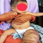 Penderita Limfangioma di Pamekasan Kakinya Kian Membesar dan Keluarkan Bau Tak Sedap