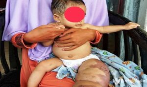 Penderita Limfangioma di Pamekasan Kakinya Kian Membesar dan Keluarkan Bau Tak Sedap