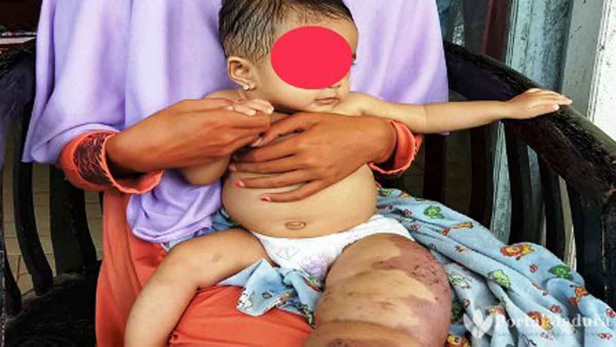 Penderita Limfangioma di Pamekasan Kakinya Kian Membesar dan Keluarkan Bau Tak Sedap