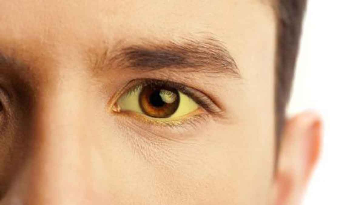  Mata Kuning  Tanda Terkena Penyakit Hepatitis Benarkah 